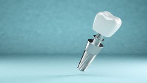 CUANTO DURAN LOS IMPLANTES DENTALES