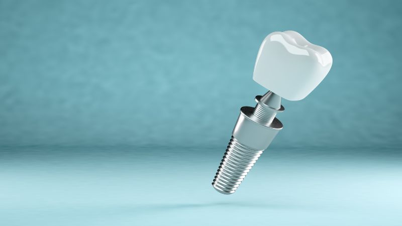 CUANTO DURAN LOS IMPLANTES DENTALES